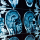 Image for article titled A Deadly Cancer Hijacks the Brain to Render Itself Untreatable, Study Finds